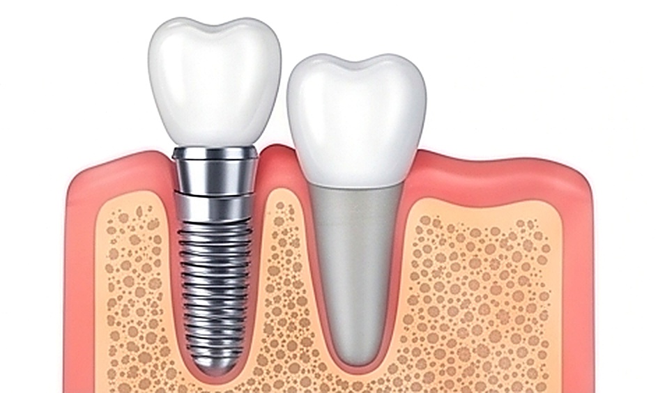 Dental Implant in Muscat