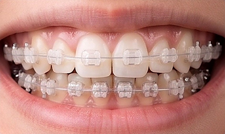 Orthodontics in Muscat