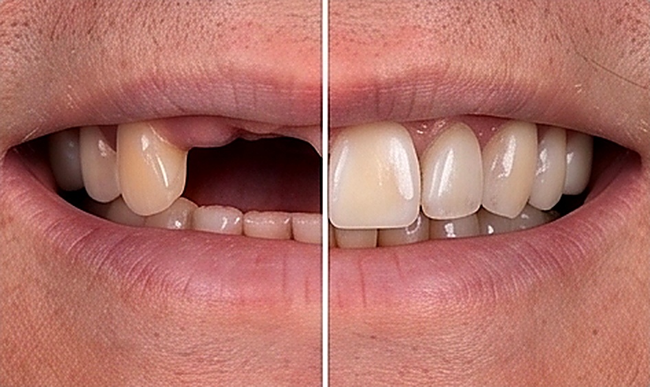 Replacement of Teeth in Muscat