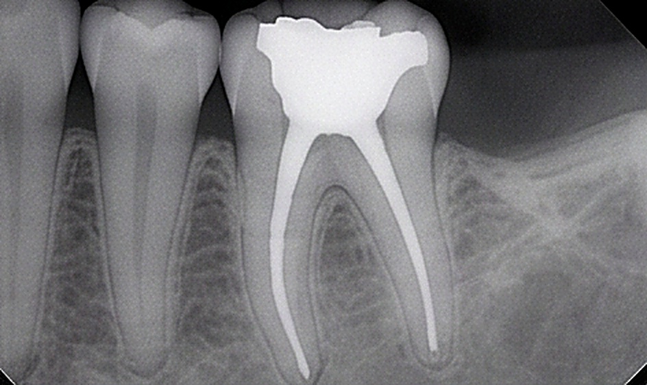 Root Canal in Muscat
