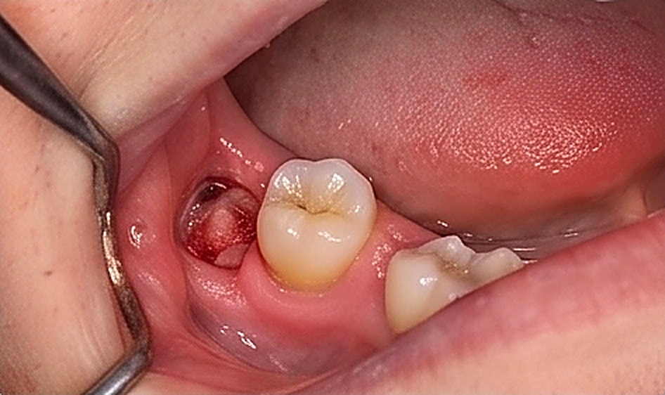 Surgical Extractions in Muscat