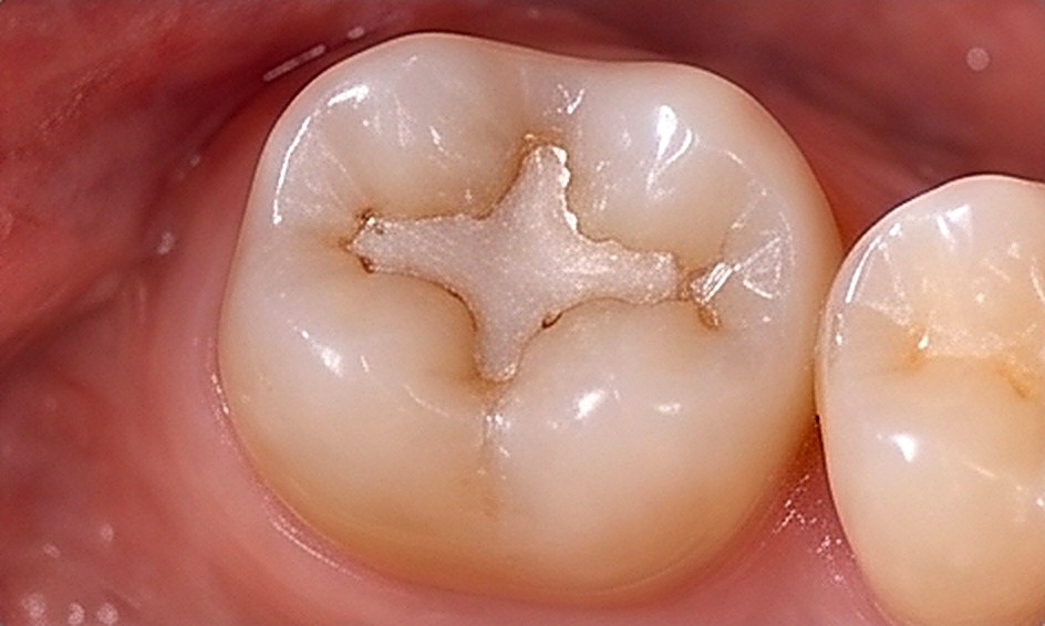 Teeth Fillings in Muscat