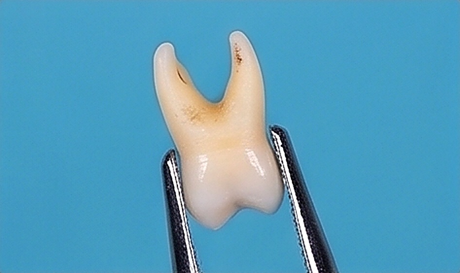 Teeth Removal in Muscat