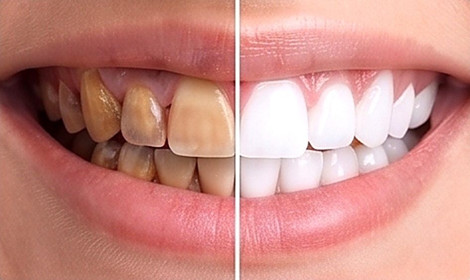 Teeth Whitening in Muscat