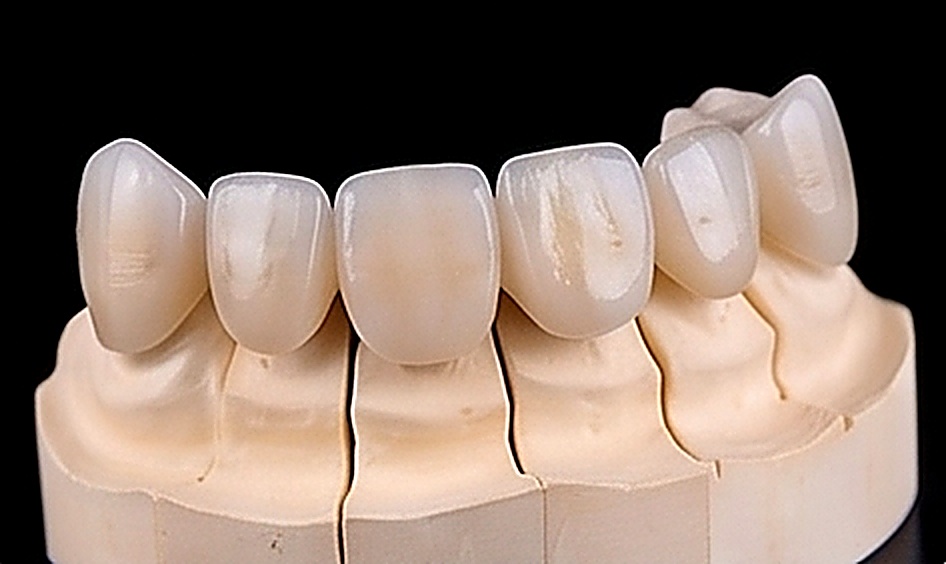 Veneers Zirconium Bridges in Muscat