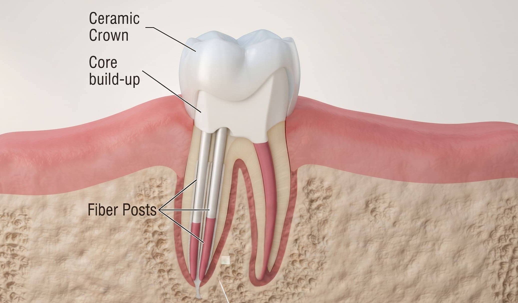 dental post and core in Oman